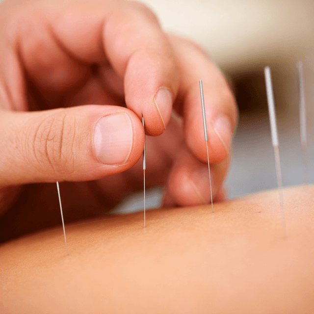 Acupuncture Therapy